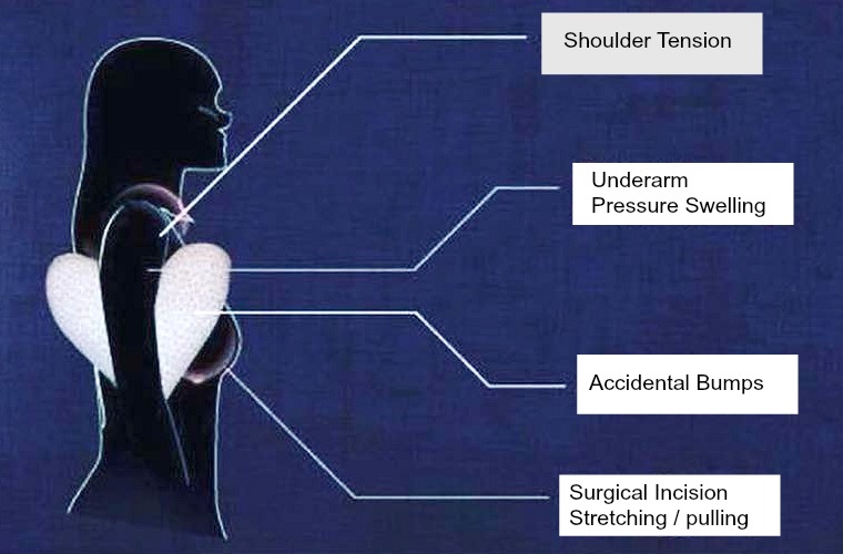 How Mastectomy Underarm Pillows Help